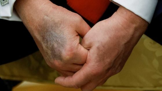 كدمات ترامب تثير الجدل حول وضعه الصحي والبيت الأبيض يوضح