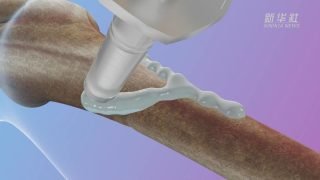 “ثورة في طب العظام” .. استطاع علماء من الصين إبتكار لاصقًا طبيًا يستطيع إصلاح الكسور في العظام خلال “ثلاث دقائق فقط”