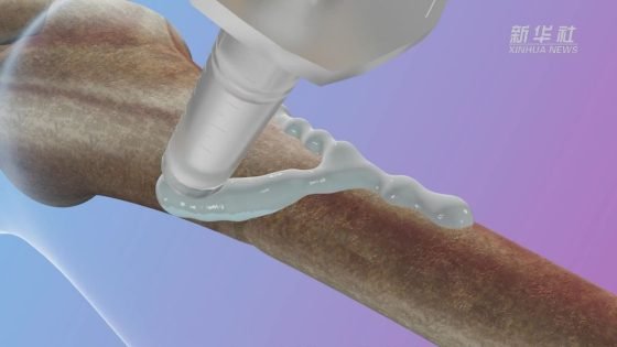 “ثورة في طب العظام” .. استطاع علماء من الصين إبتكار لاصقًا طبيًا يستطيع إصلاح الكسور في العظام خلال “ثلاث دقائق فقط”