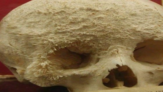 هذا هو شكل انتشار السرطان، اللي نسميه “سرطان العظام”. النقيلة يعني إن السرطان ما بقي في المكان اللي بدأ فيه، بل انتشر لمكان ثاني في الجسم