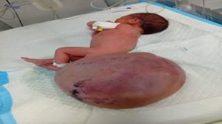 مدير مجمع الشفاء في غزة “محمد أبو سلمية” ينشر صورة لطفل وُلد بعمر 8 أشهر وهو يعاني من تشوه ورمي كبير في منطقة العصعص