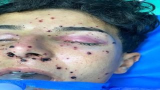 فريق طبي في مستشفى الزبير العام بالبصرة يتمكنون من إنقاذ شاب من فقدان البصر؛ إثر إصابته بالقرنية نتيجة انفجار بطارية شحن سيارة، بعد عملية جراحية دقيقة تضمنت إزالة الشظايا وخياطة القرنية وغسل النزف.