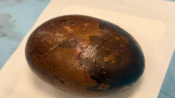 فريق طبي في الموصل ينجح في رفع حصاة بوزن نصف كيلوغرام من مثانة مريض بعمر 45 عاماً.