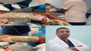 إجراء عملية نوعية لمريض يعاني من حروق بنسبة 45% باستخدام جلد السمك كبديل للترقيع الجلدي في ميسان