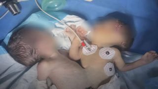 صحة كركوك: نجاح فريق طبي في إجراء أول عملية من نوعها في تاريخ المحافظة لفصل توأم سيامي