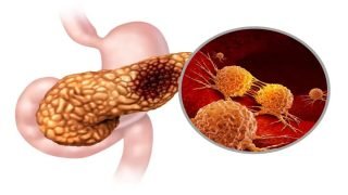 أعلن فريق من العلماء في إسبانيا التوصل إلى علاج جديد لسرطان البنكرياس، أحد أكثر أنواع السرطان شراسة، مؤكدين أن النتائج الأولية أظهرت استجابة واعدة، مع استمرار الدراسات السريرية قبل اعتماده رسميًا